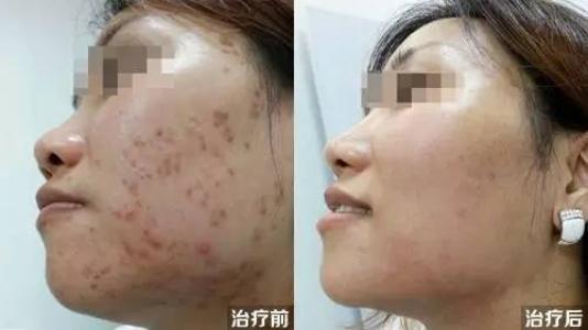武漢哪家醫(yī)院治療微整妊娠紋效果好？2023年口碑前十的正規(guī)美容醫(yī)院推薦！