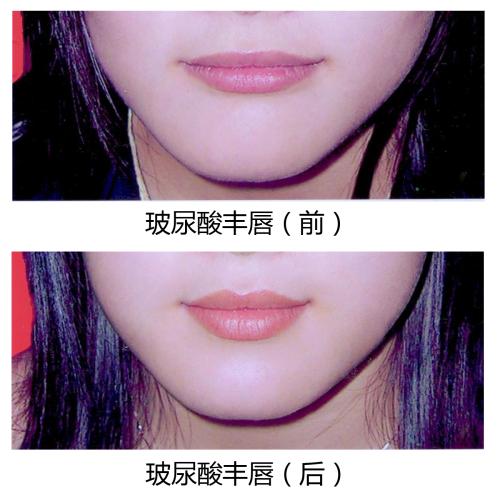 沈陽醫(yī)科大吸脂的效果好嗎？有哪些優(yōu)勢？