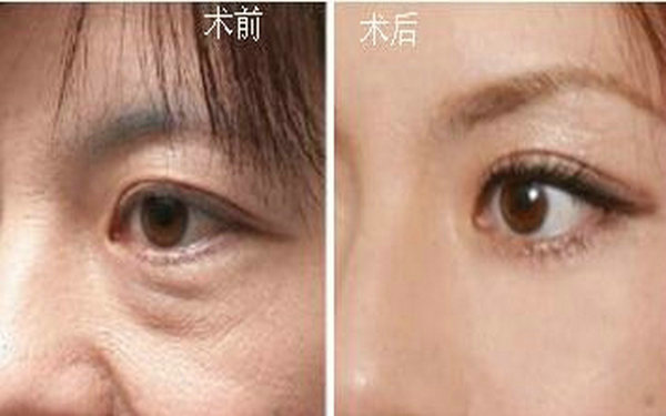福建哪家醫(yī)院最適合祛除鼻溝紋？2023年最受贊譽(yù)的前10家醫(yī)院推薦！