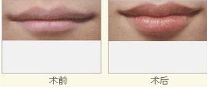 激光祛除眼袋會帶來哪些不良反應(yīng)？