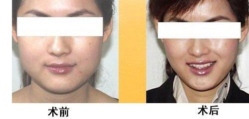 佛山妊娠紋去除肉毒素整形美容醫(yī)院排名大揭秘！2023年佛山妊娠紋去除醫(yī)院口碑TOP10強評比！