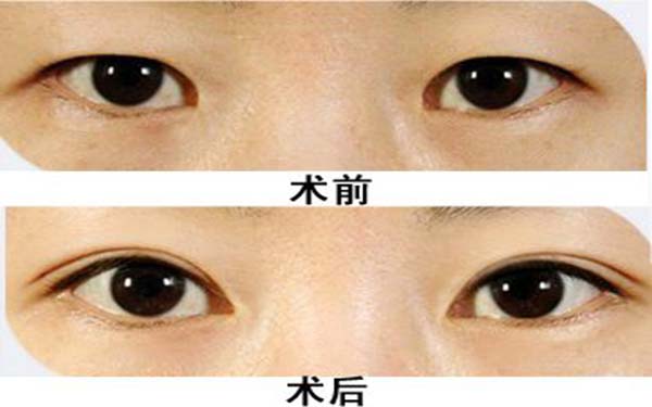 東莞眼角紋醫(yī)療美容醫(yī)院哪家好？TOP10細(xì)胞激光去眼角紋醫(yī)院推薦！2023最受專家認(rèn)可！