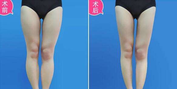 寧波哪家醫(yī)院的拉皮去皺手術(shù)更專業(yè)？2023寧波拉皮去皺手術(shù)權(quán)威醫(yī)院排行真實反饋，速查！