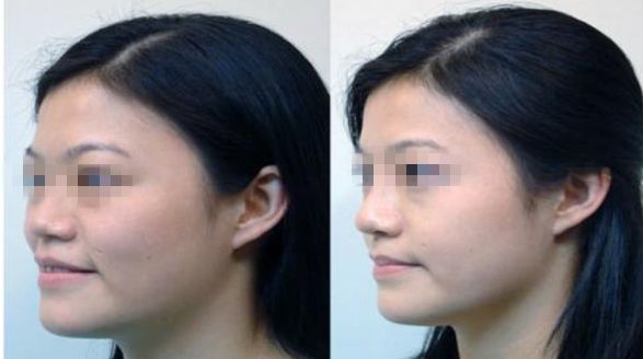 整形醫(yī)生解答：十個鼻子九個修復(fù)的真相！