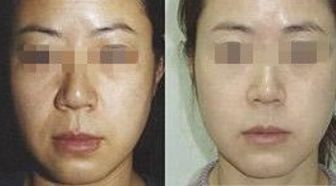 上海整形隆胸推薦：伊萊美和華美的資深豐胸專家為您打造完美曲線