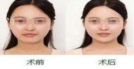 揭秘祛除懸針紋的注射玻尿酸技術，擁有年輕容顏不再是夢