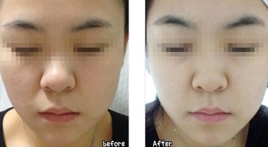 河源植發(fā)價格及推薦：探尋華美發(fā)際線種植3999元方案