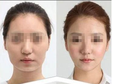 杭州時(shí)光胡斌鼻整形詳細(xì)解析：技術(shù)解析 + 風(fēng)格點(diǎn)評(píng)