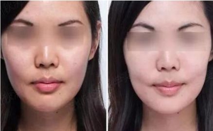 宜昌二醫(yī)院整形科手術費用及案例分享，效果如何？