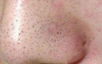 牙齒矯正概念錯？矯正后穩(wěn)如初！