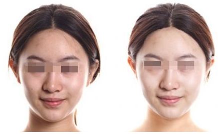 武漢星妍醫(yī)療美容醫(yī)院：熱瑪吉手術費用及效果如何？
