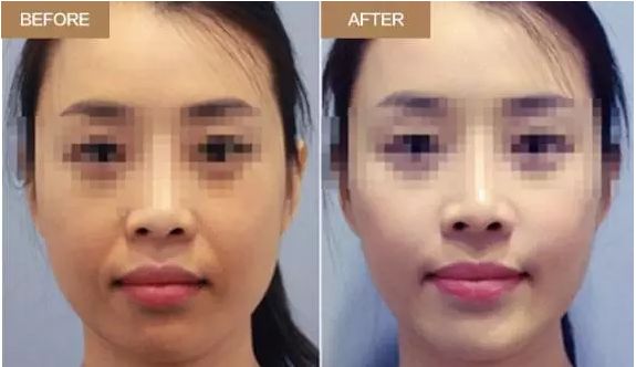 改善腿型的小竅門，北京知音整形帶您解決O型腿問題