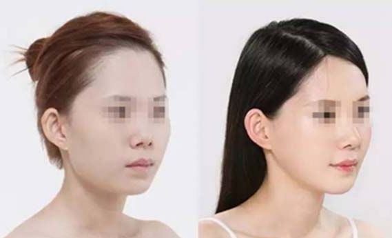 激光美容項目大揭秘：祛斑、抗衰、脫毛全方位解析！