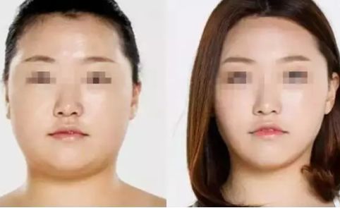 南京 V 型下頜角整形：權威醫(yī)院推薦清單