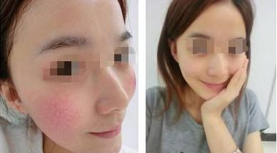 醫(yī)美光電項(xiàng)目避坑秘笈：小白入門(mén)必看
