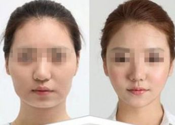 南寧祛痘印哪家醫(yī)院好？口碑正規(guī)醫(yī)院推薦