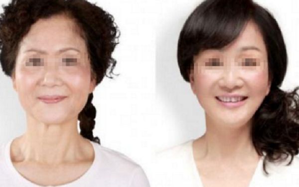 侯澤民假體隆胸手術(shù)效果分享