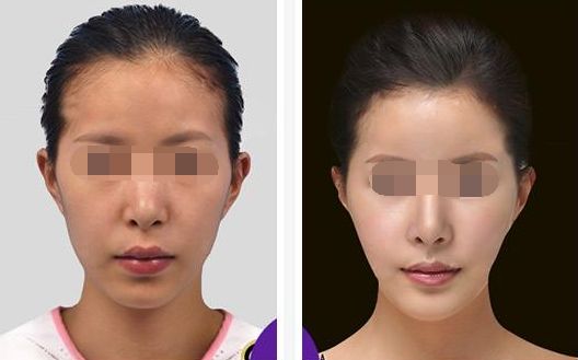 六盤水利美康雙眼皮整形口碑醫(yī)生推薦，真實(shí)案例圖文分享