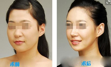 雙眼皮手術(shù)后消腫指南：最快捷方法揭秘