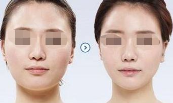 鼻小柱延長，打造精致鼻型