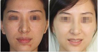 廣州華美郝永生操刀，網(wǎng)紅分享內(nèi)窺鏡假體隆胸真實(shí)體驗(yàn)：A杯變C杯！