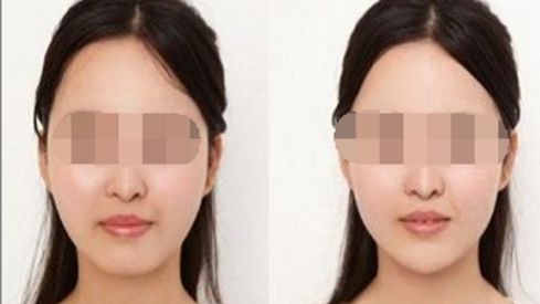 重慶哪家隆胸醫(yī)院好？假體隆胸、自體脂肪豐胸價格一覽