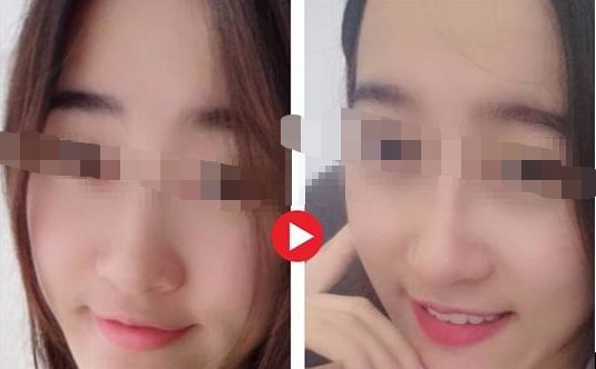 重慶哪家醫(yī)院做顴骨整形好？重慶面部磨骨有名氣的醫(yī)院推薦！