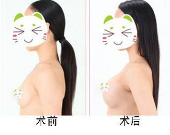 韓嘯棉花糖隆胸與魔滴假體隆胸手感對比：優(yōu)缺點大揭秘