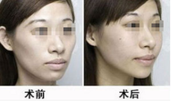 濟南鼻子整形醫(yī)院排名及隆鼻技術(shù)醫(yī)生推薦，價格參考