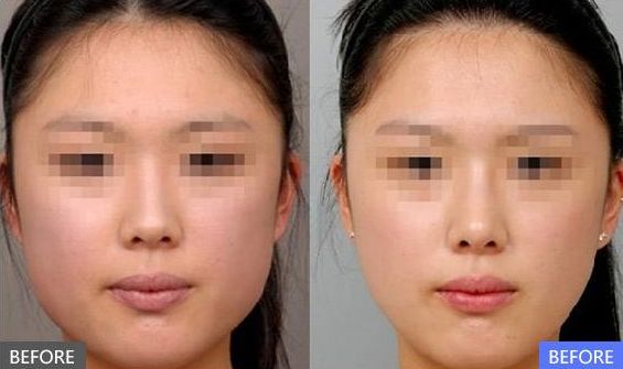 南寧面部提升醫(yī)院對比：芯玥和美恒的性價比選擇