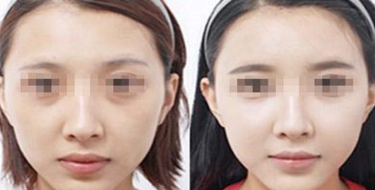 自體脂肪隆胸效果維持多久？豐胸效果能夠持續(xù)多長時(shí)間？