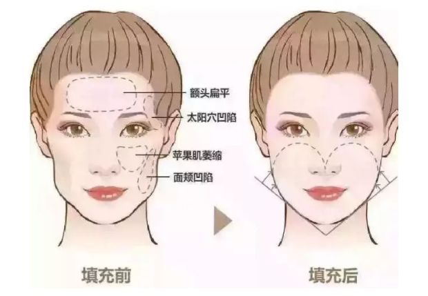 深圳大學(xué)第一附屬醫(yī)院整形美容科綜合評價及下頜角整形案例分享