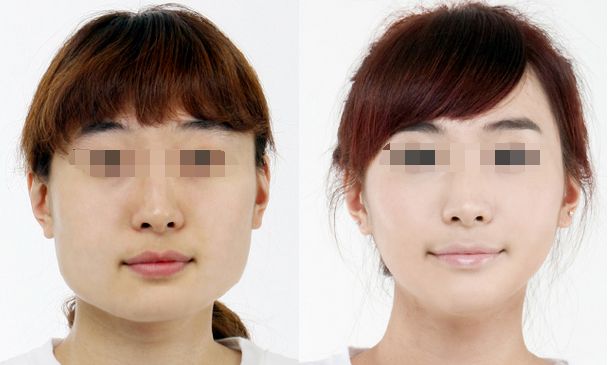 成都哪個醫(yī)生抽脂效果好？盛陽、馬懿、王曾思對比