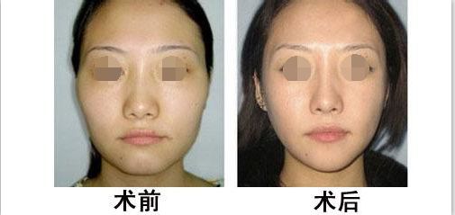 西安哪家拉皮除皺醫(yī)院口碑好？推薦面部提升醫(yī)生及價格