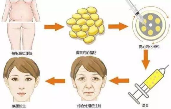 自體脂肪豐胸多久恢復(fù)自然？優(yōu)缺點(diǎn)詳解