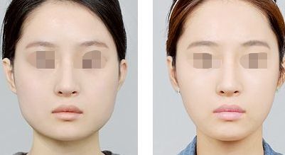 探秘萊州市人民醫(yī)院整形美容科：科隆胸技術詳解及收費參考