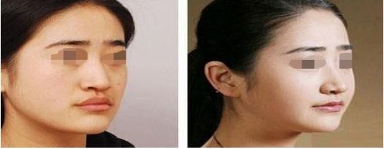 Profile超級(jí)平臺(tái)BB光技術(shù)：擁抱青春煥發(fā)，重點(diǎn)揭秘抗衰老新法寶