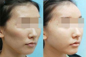 成都脂肪填充實力派醫(yī)院推薦：潤美玉之光、恒博天姿
