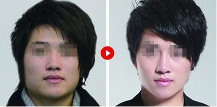 昆明韓辰王德寧受損眼修復(fù)與鼻形贊譽(yù)：真實(shí)案例解析