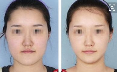 北京哪家醫(yī)院做開眼角整形好？前六家供你參考