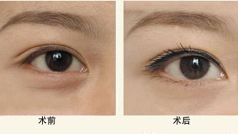 開眼角有哪些醫(yī)院能做好？這幾家專業(yè)雙眼皮修復(fù)中心靠譜又高效！