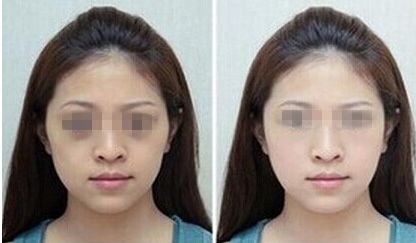 北京注射玻尿酸費(fèi)用及醫(yī)院推薦：看濡白天使、喬雅登價(jià)格