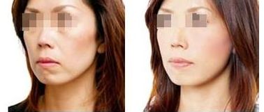 廣州豐胸哪位醫(yī)生好：郝永生和許楊濱對比分析