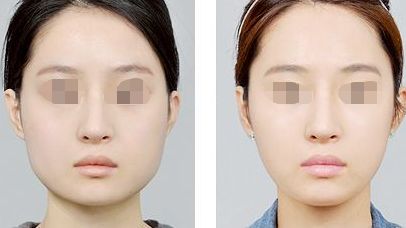 西安醫(yī)學院二附院隆胸手術效果解析：專家坐診+真實術后反饋