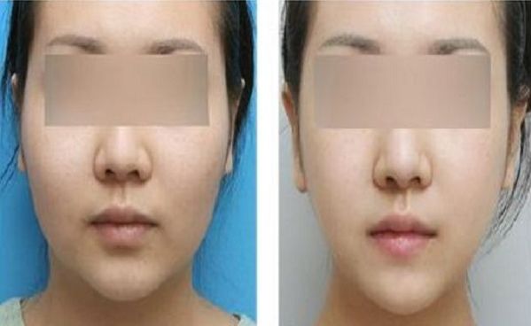 南京隆鼻醫(yī)院口碑對比：華美和施爾美誰更勝一籌？