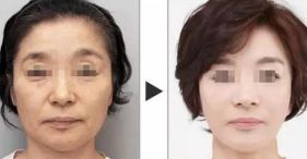 填充完美額頭：自體脂肪填充術(shù)全面攻略指南