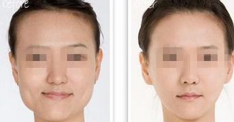 國(guó)內(nèi)口碑頗佳的脂肪豐臀醫(yī)院推薦：上海薇琳和北京藝星