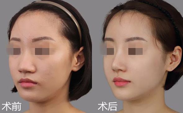 伊顏美雙眼皮哪種方式更適合？價(jià)格及效果對(duì)比分析