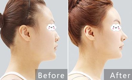 實(shí)測：愛德麗格王香平雙眼皮修復(fù)口碑解析，效果如何？