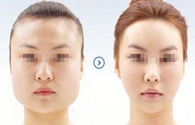 林高萍吸脂手術(shù)效果如何？實力醫(yī)生揭秘！